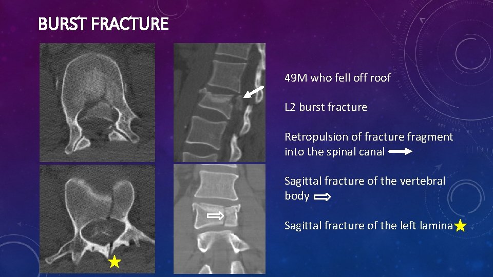 BURST FRACTURE 49 M who fell off roof L 2 burst fracture Retropulsion of