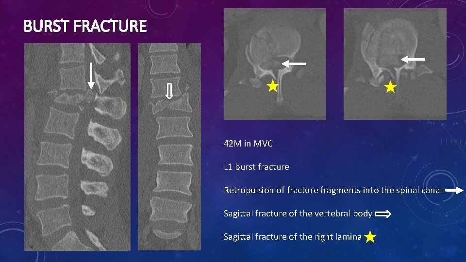 BURST FRACTURE 42 M in MVC L 1 burst fracture Retropulsion of fracture fragments