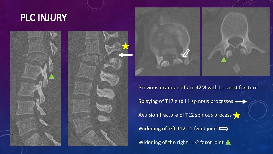 PLC INJURY Previous example of the 42 M with L 1 burst fracture Splaying