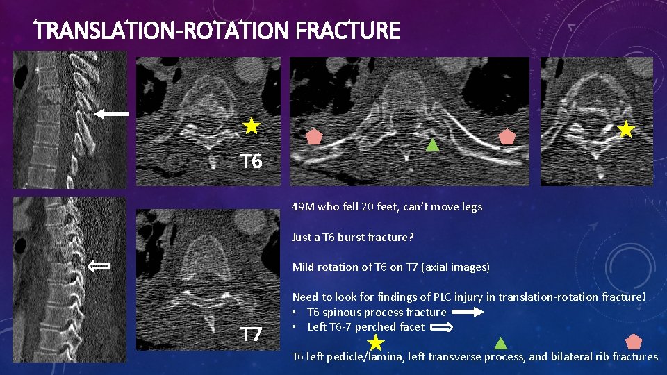 TRANSLATION-ROTATION FRACTURE T 6 49 M who fell 20 feet, can’t move legs Just