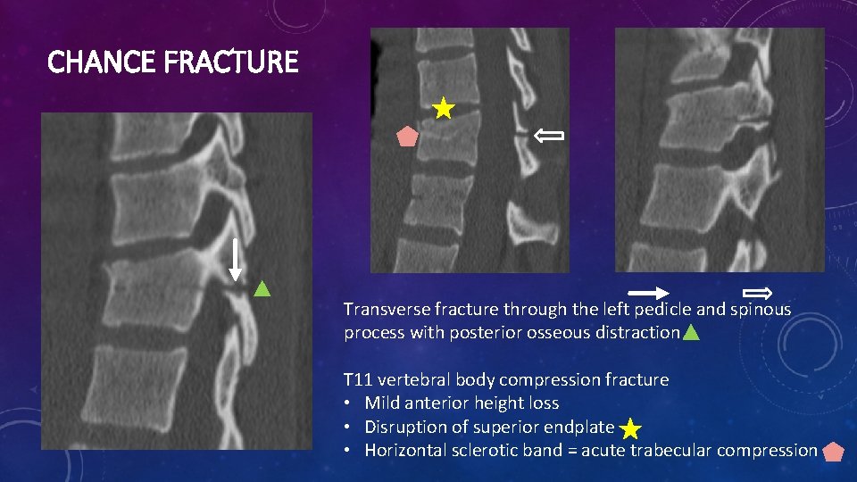CHANCE FRACTURE Transverse fracture through the left pedicle and spinous process with posterior osseous