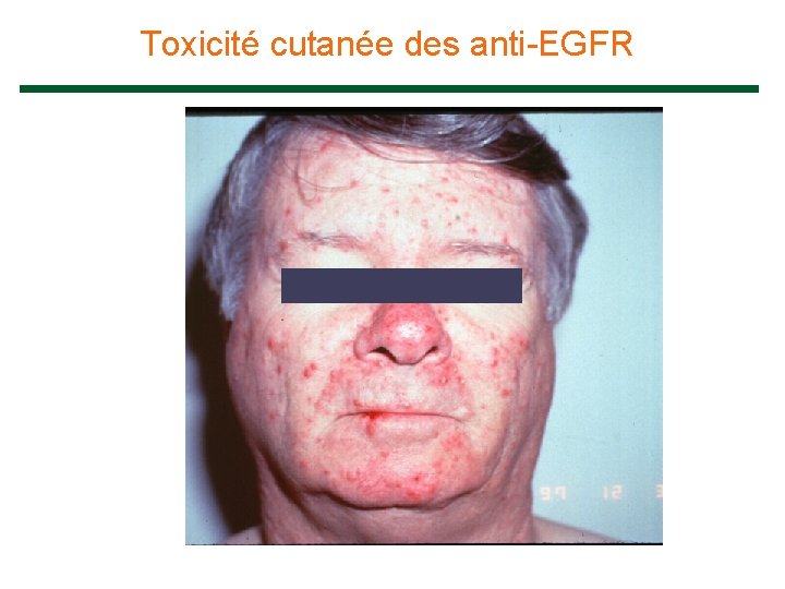 Toxicité cutanée des anti-EGFR 