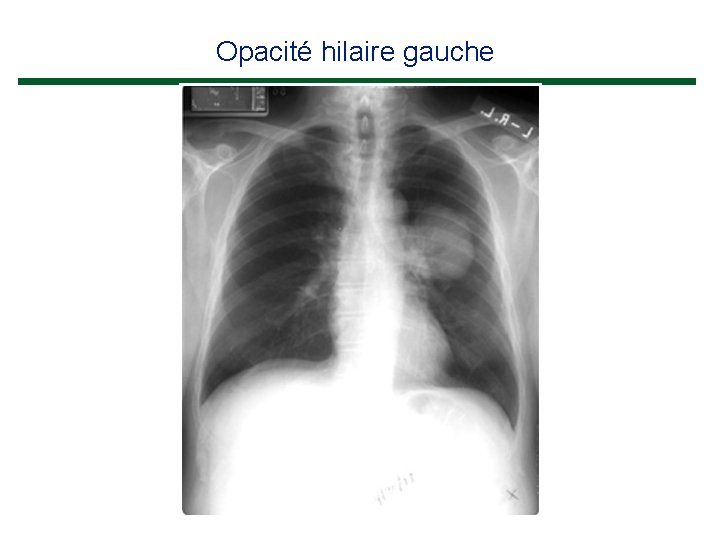 Opacité hilaire gauche 