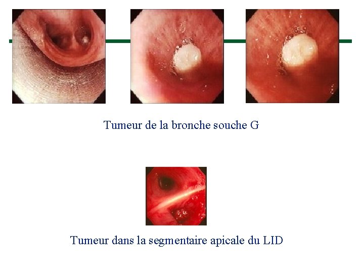 Tumeur de la bronche souche G Tumeur dans la segmentaire apicale du LID 