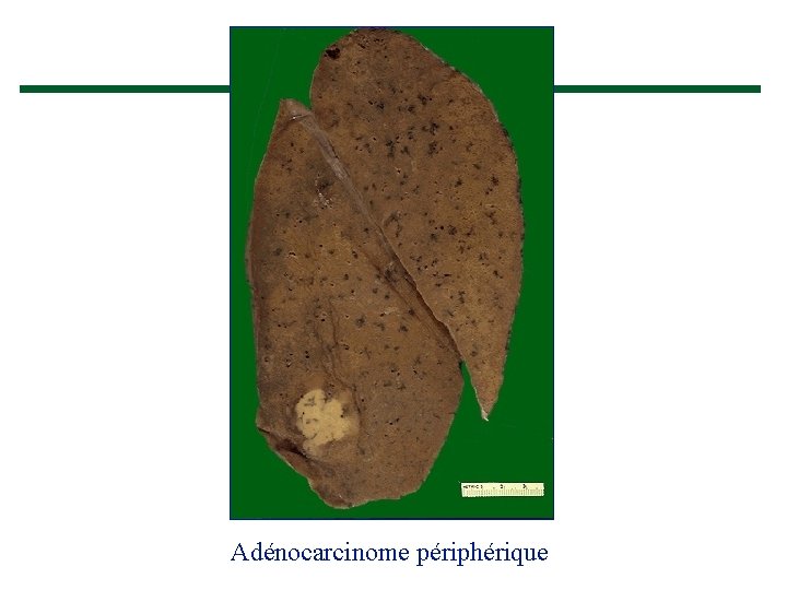 Adénocarcinome périphérique 