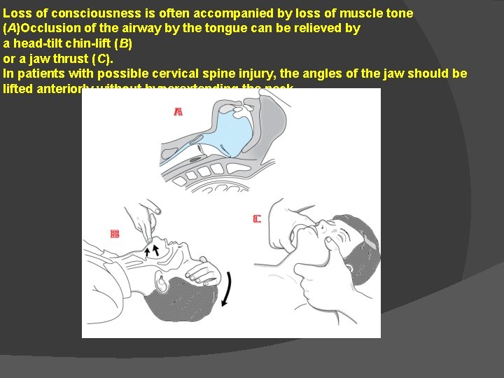 Loss of consciousness is often accompanied by loss of muscle tone (A)Occlusion of the