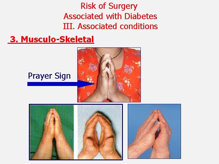 Risk of Surgery Associated with Diabetes III. Associated conditions 3. Musculo-Skeletal Prayer Sign 