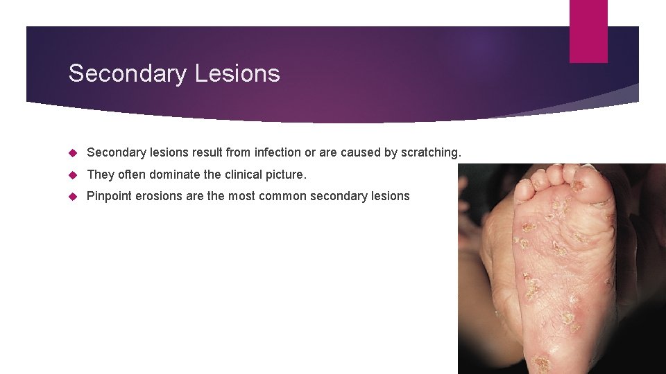 Secondary Lesions Secondary lesions result from infection or are caused by scratching. They often