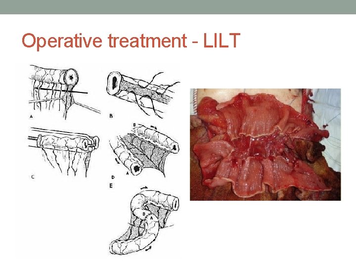 Operative treatment - LILT 