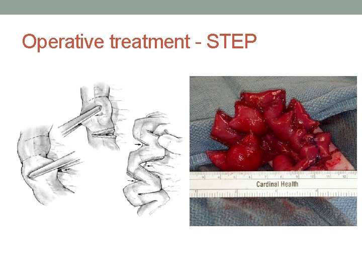 Operative treatment - STEP 