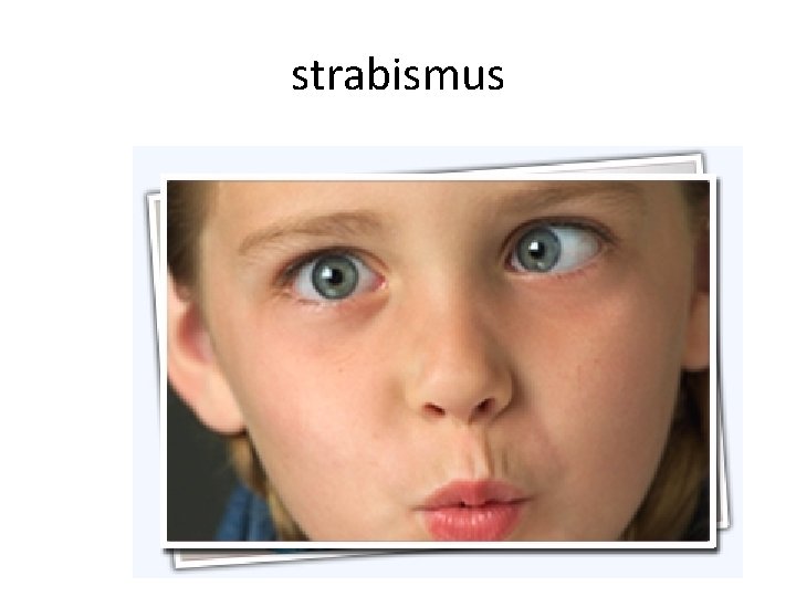 strabismus 
