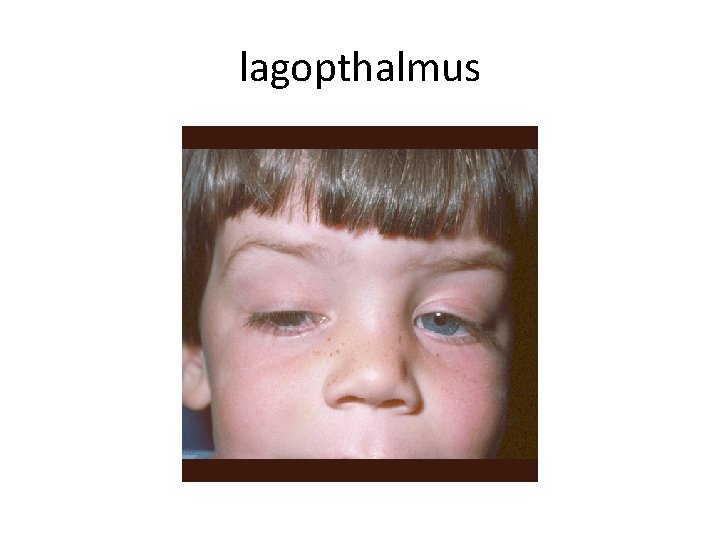 lagopthalmus 