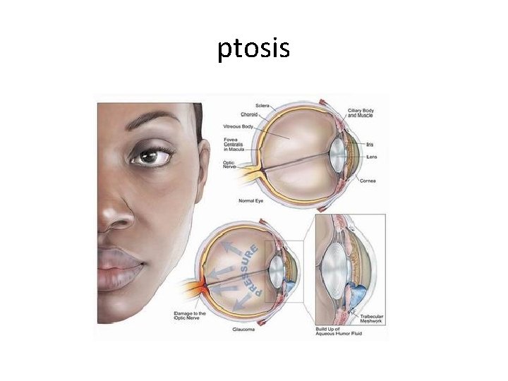 ptosis 