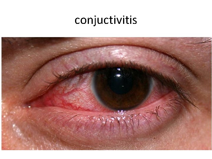 conjuctivitis 