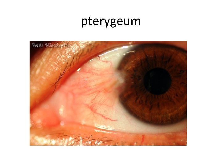 pterygeum 