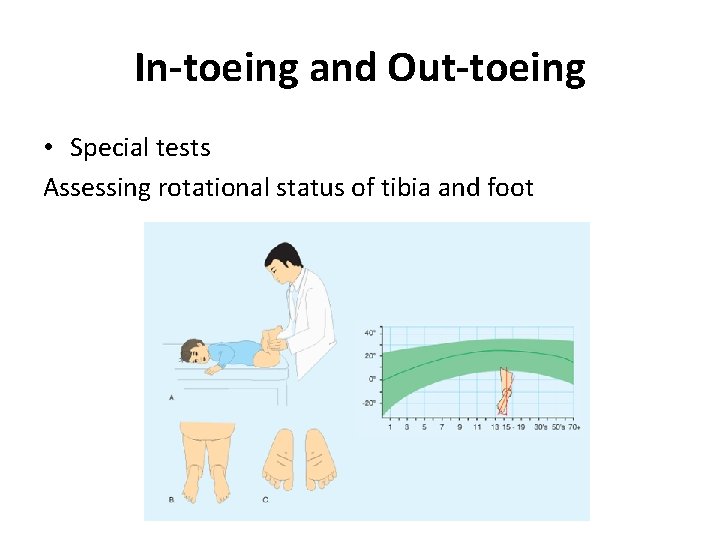In-toeing and Out-toeing • Special tests Assessing rotational status of tibia and foot 