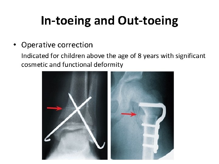 In-toeing and Out-toeing • Operative correction Indicated for children above the age of 8