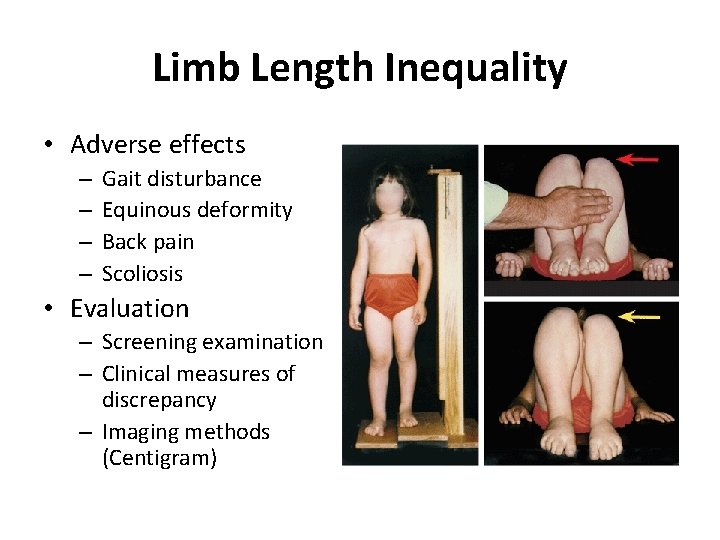 Limb Length Inequality • Adverse effects – – Gait disturbance Equinous deformity Back pain