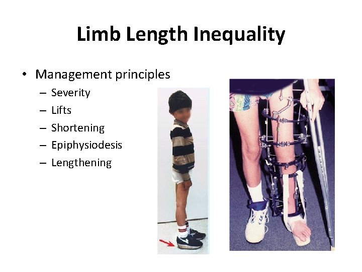 Limb Length Inequality • Management principles – – – Severity Lifts Shortening Epiphysiodesis Lengthening