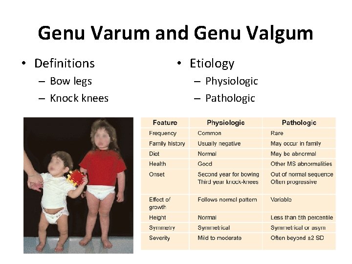 Genu Varum and Genu Valgum • Definitions – Bow legs – Knock knees •
