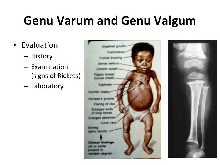 Genu Varum and Genu Valgum • Evaluation – History – Examination (signs of Rickets)