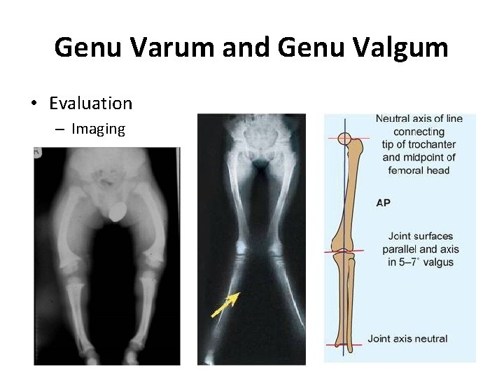 Genu Varum and Genu Valgum • Evaluation – Imaging 