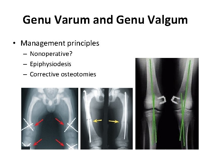 Genu Varum and Genu Valgum • Management principles – Nonoperative? – Epiphysiodesis – Corrective