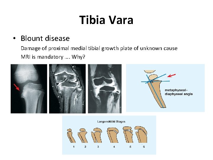 Tibia Vara • Blount disease Damage of proximal medial tibial growth plate of unknown