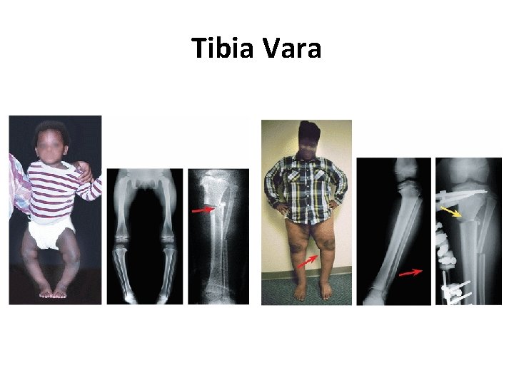 Tibia Vara 