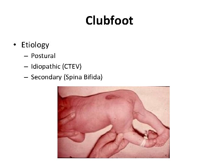 Clubfoot • Etiology – Postural – Idiopathic (CTEV) – Secondary (Spina Bifida) 