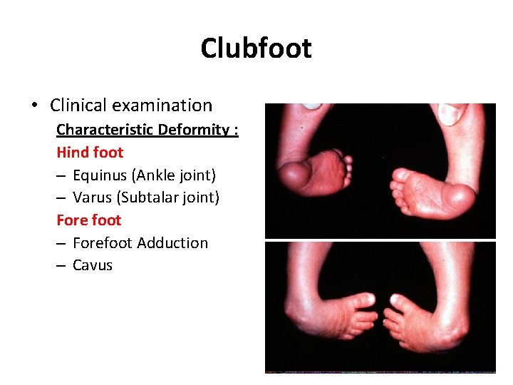 Clubfoot • Clinical examination Characteristic Deformity : Hind foot – Equinus (Ankle joint) –