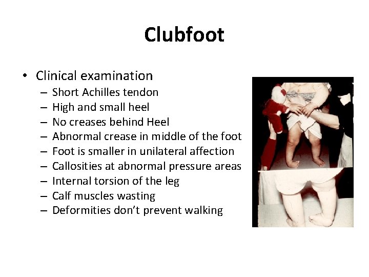 Clubfoot • Clinical examination – – – – – Short Achilles tendon High and