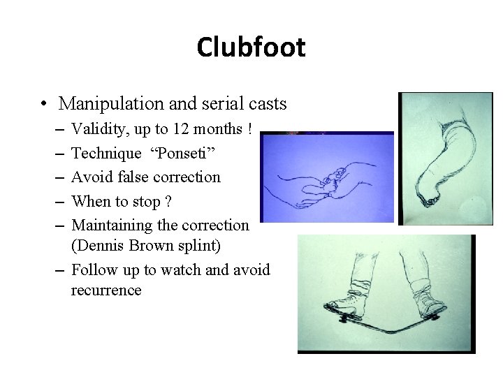 Clubfoot • Manipulation and serial casts – – – Validity, up to 12 months