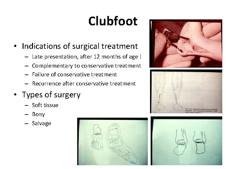 Clubfoot • Indications of surgical treatment – – Late presentation, after 12 months of