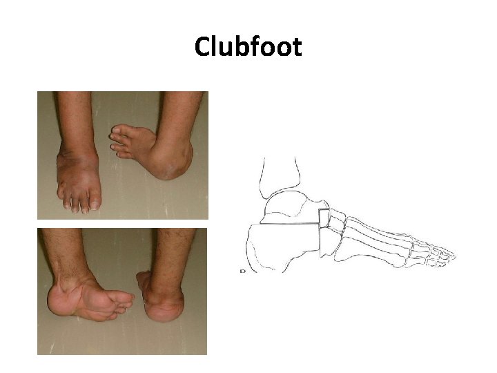 Clubfoot 