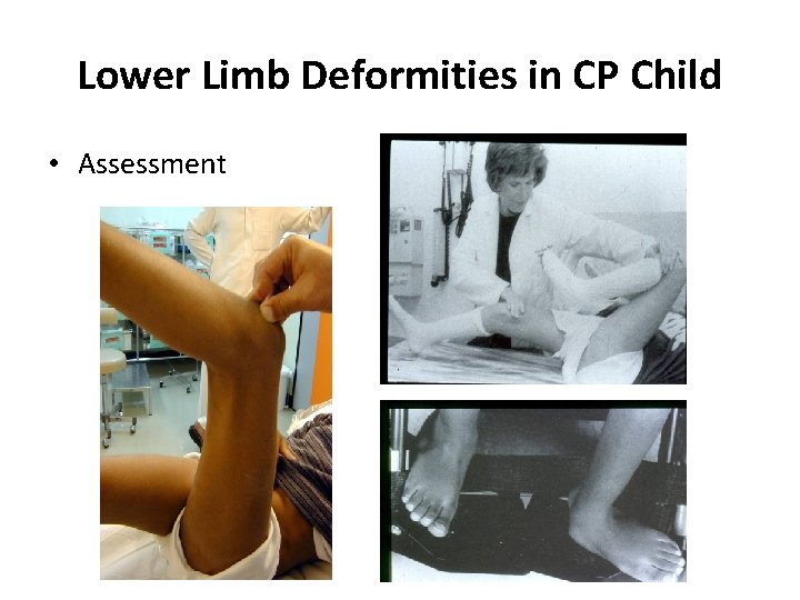 Lower Limb Deformities in CP Child • Assessment 