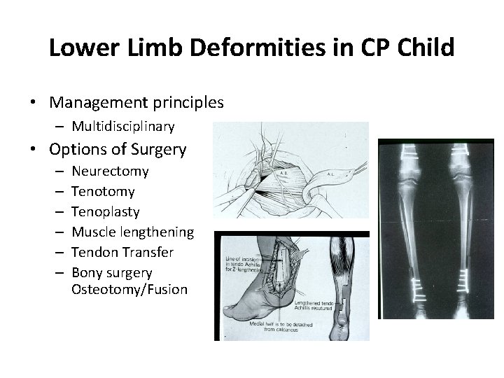 Lower Limb Deformities in CP Child • Management principles – Multidisciplinary • Options of