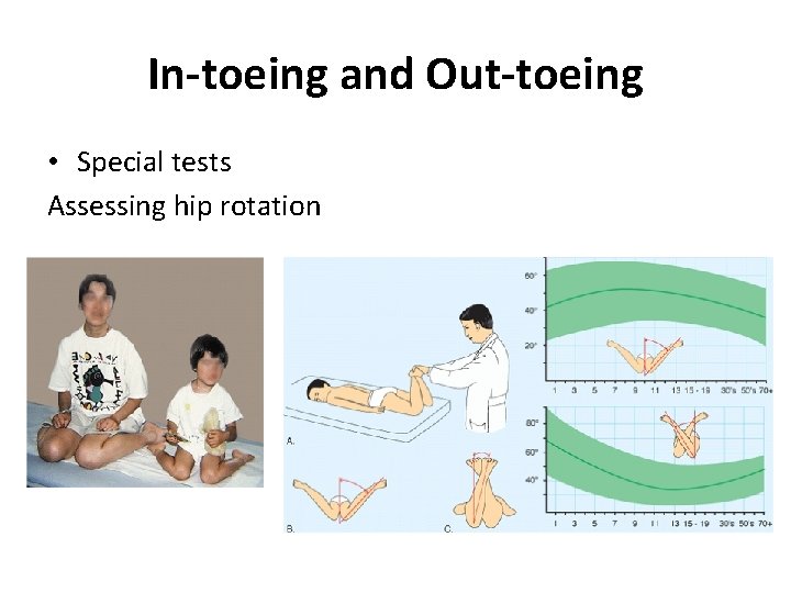 In-toeing and Out-toeing • Special tests Assessing hip rotation 