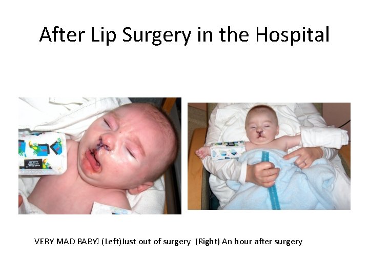 After Lip Surgery in the Hospital VERY MAD BABY! (Left)Just out of surgery (Right)