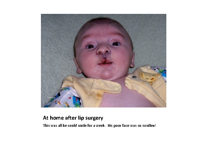 At home after lip surgery This was all he could smile for a week.