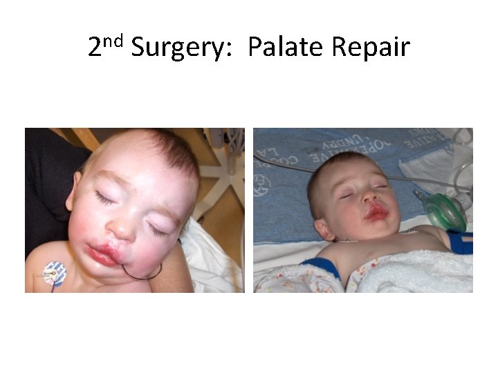 2 nd Surgery: Palate Repair 