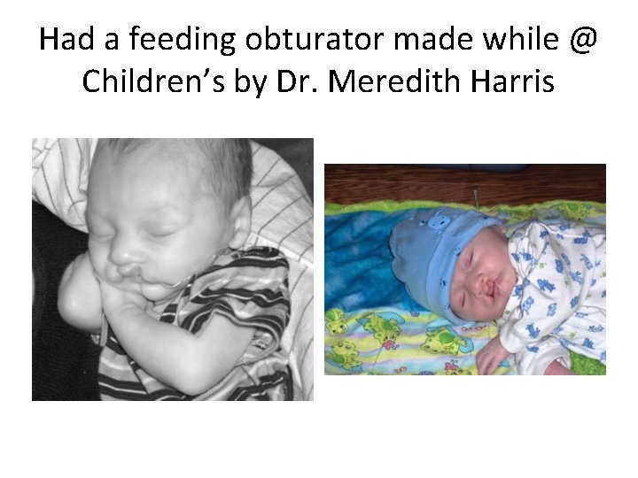 Had a feeding obturator made while @ Children’s by Dr. Meredith Harris 