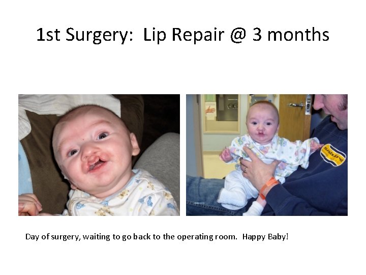 1 st Surgery: Lip Repair @ 3 months Day of surgery, waiting to go