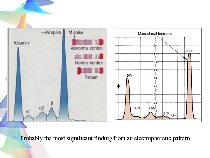 § Probably the most significant finding from an electrophoretic pattern 