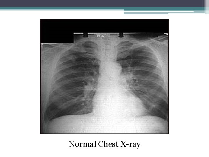 Normal Chest X-ray 