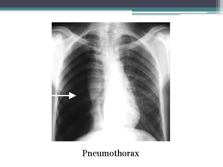 Pneumothorax 
