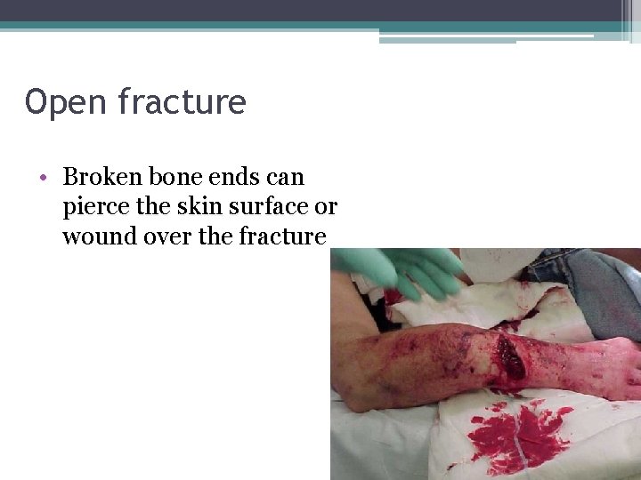 Open fracture • Broken bone ends can pierce the skin surface or wound over
