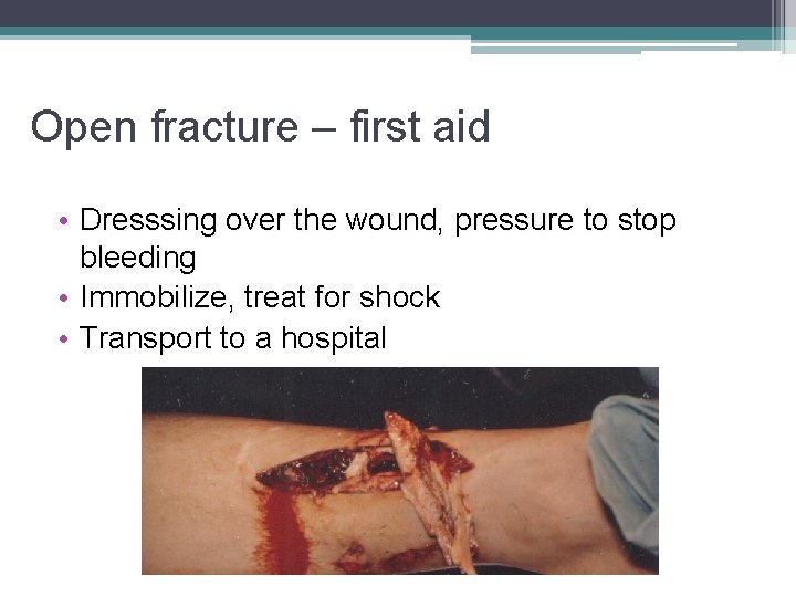 Open fracture – first aid • Dresssing over the wound, pressure to stop bleeding