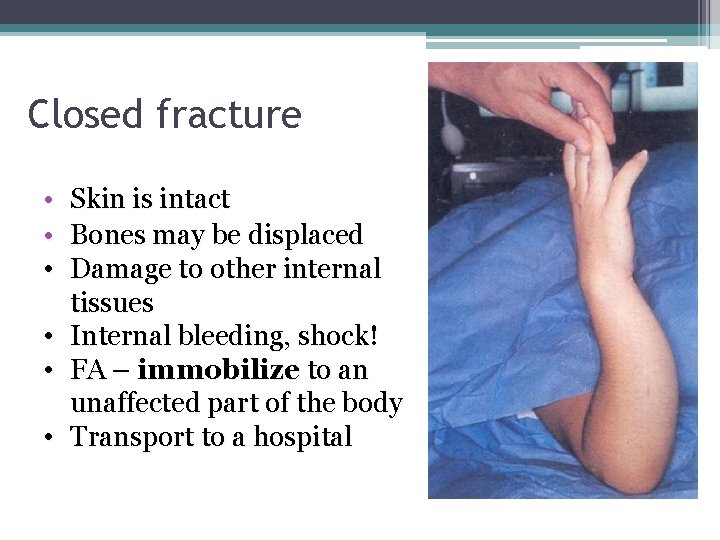 Closed fracture • • • Skin is intact Bones may be displaced Damage to