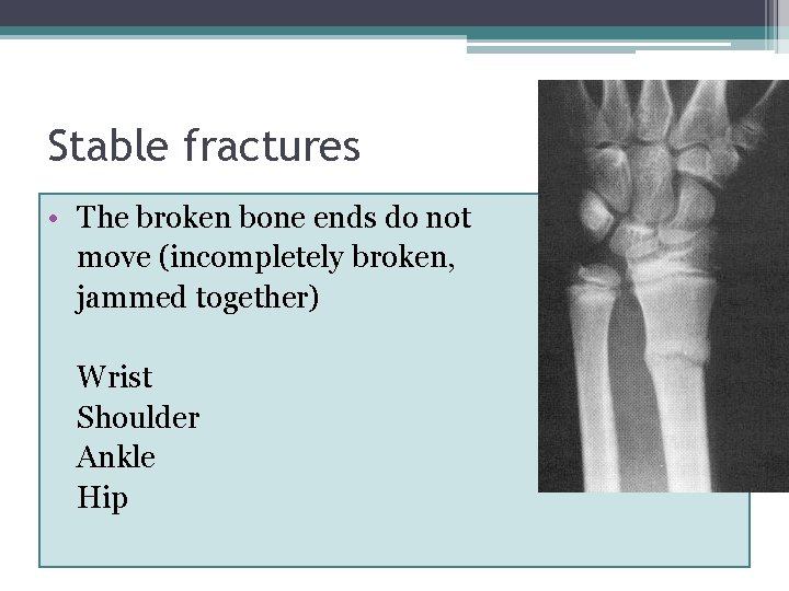 Stable fractures • The broken bone ends do not move (incompletely broken, jammed together)